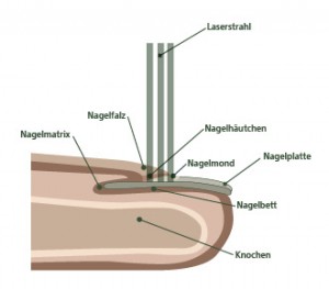 Behandlungsprinzip des Lasers: So funktioniert die Nagelpilz Behandlung